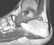 Figure 4 for case Medial subtalar joint dislocation( RID3029 )